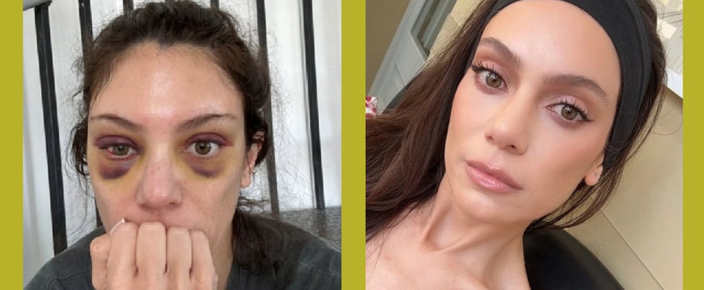 I Got An Endo Brow Lift: See Before and After Photos