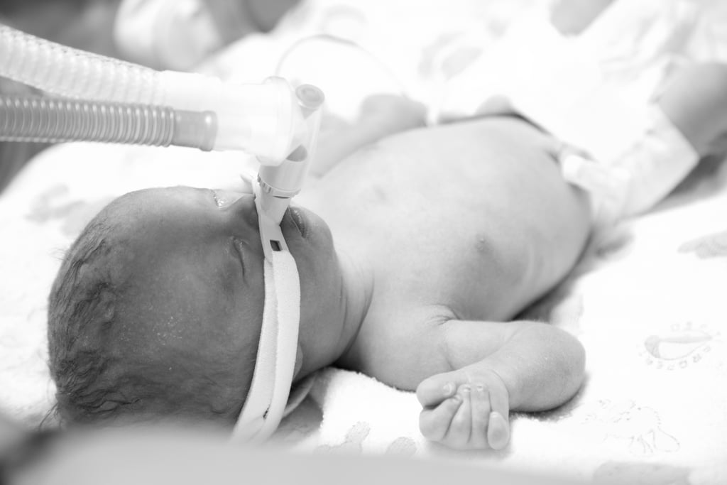 Trisomy 13 and 18 Baby Photos Trisomy 13 and 18 Baby Photos