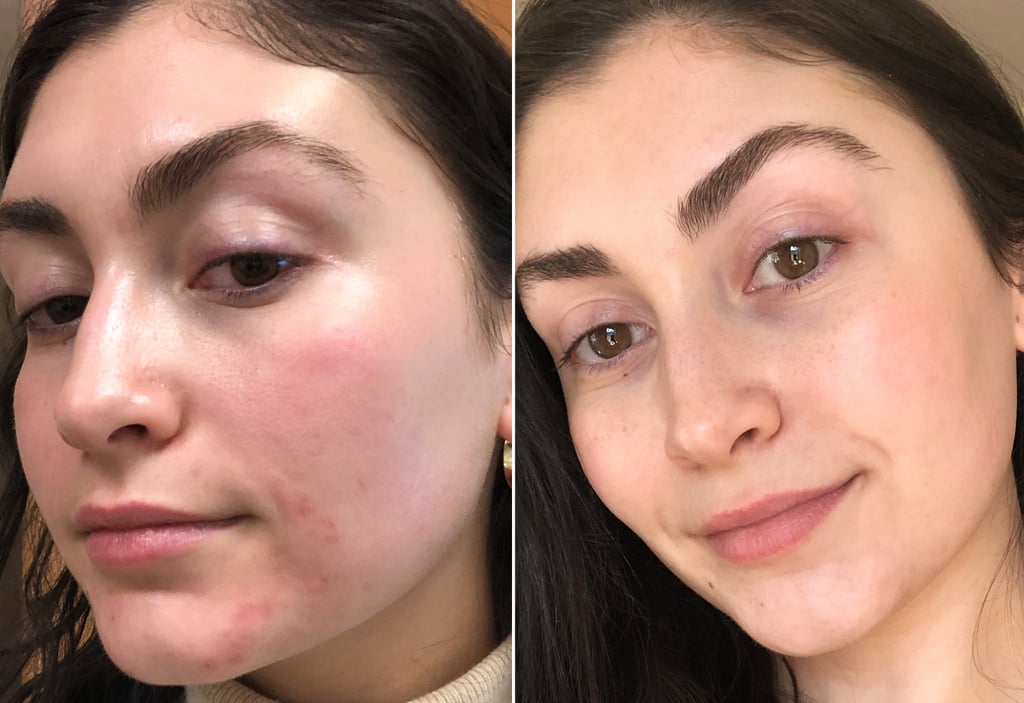 My Skin Right After Treatment vs One Month Later