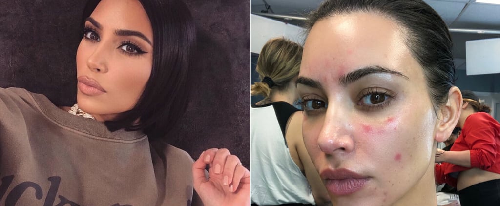 Kim Kardashian Talks About Her Psoriasis With Photos