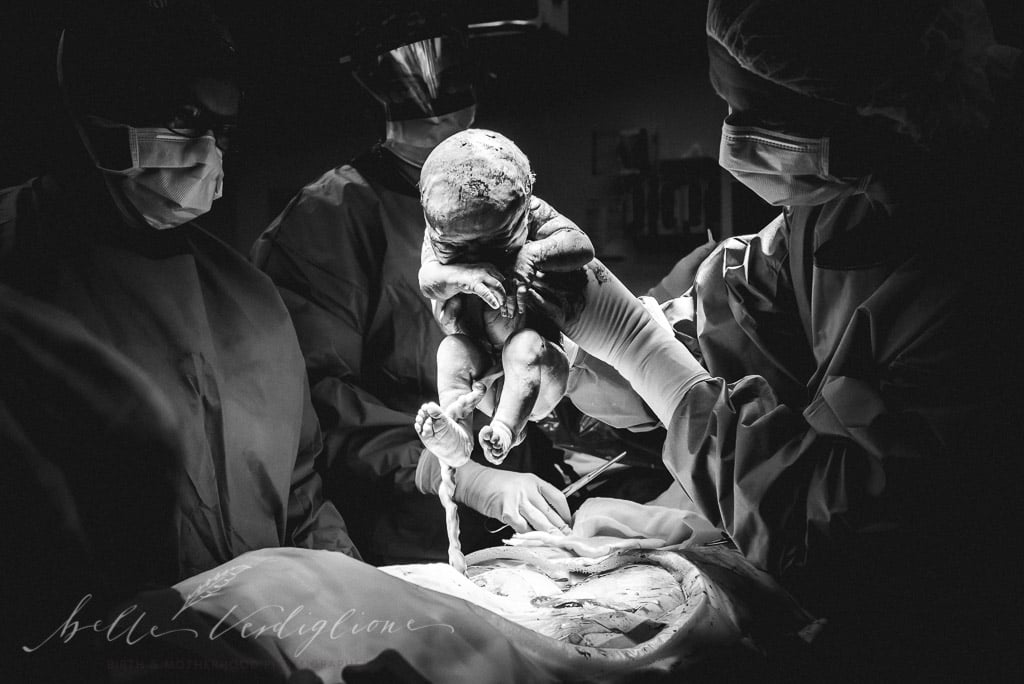 C-Section Mom Watching Baby's Birth