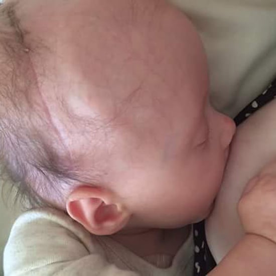Baby With Brain Cancer Breastfeeding During Chemotherapy