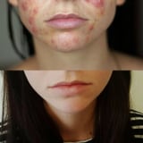 This Woman's Acne Completely Disappeared