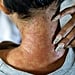 What Is Eczema and How Can You Treat it?