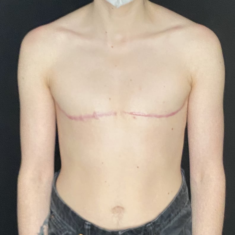 What Are the 3 Types of Surgery Scars?