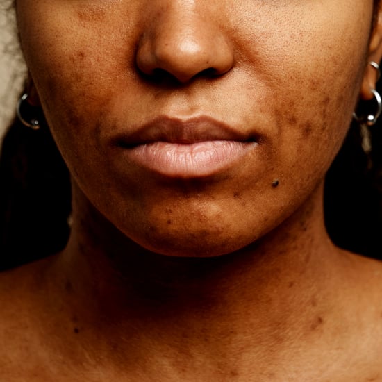 Hormonal Acne Causes and Treatments
