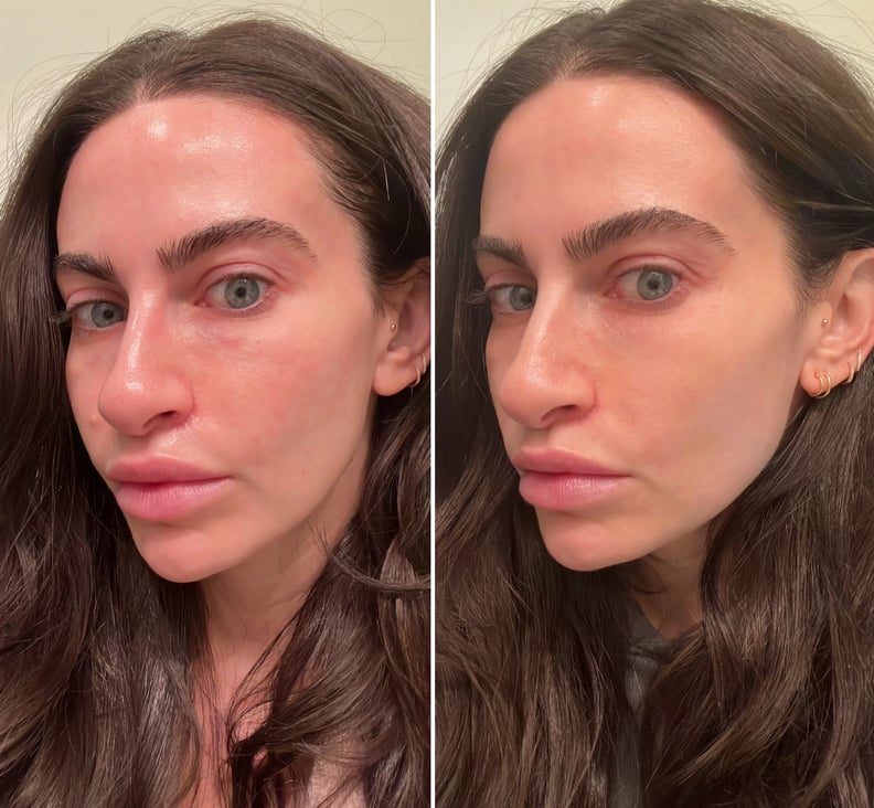 Before and after using the Lyma Laser after three weeks
