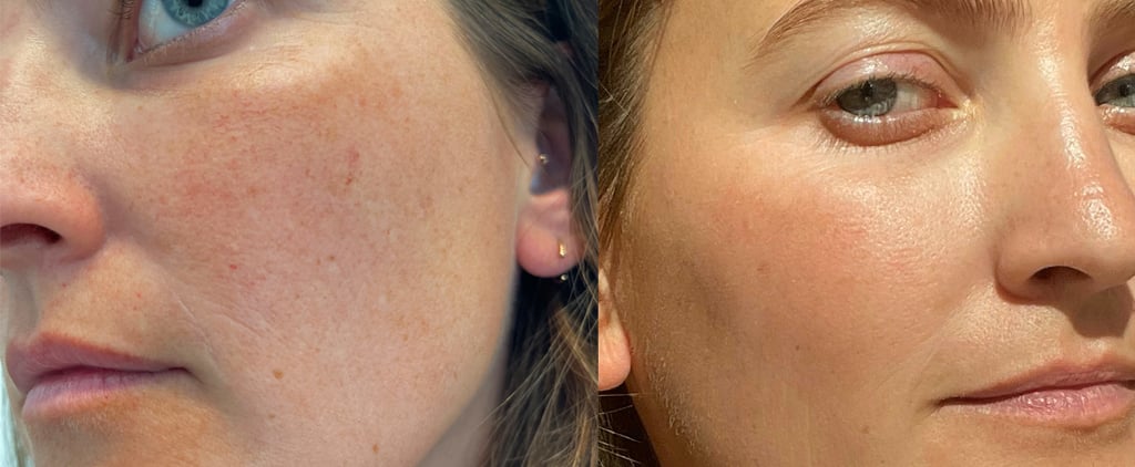 I Got a Laser Treatment to Treat the Broken Capillaries on My Face — Here's How It Went