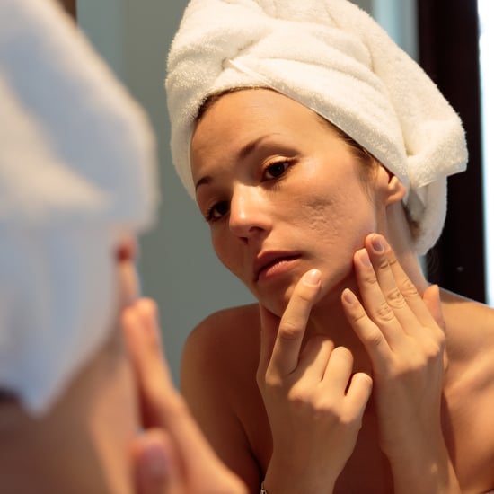 Top Acne Causes and Solutions