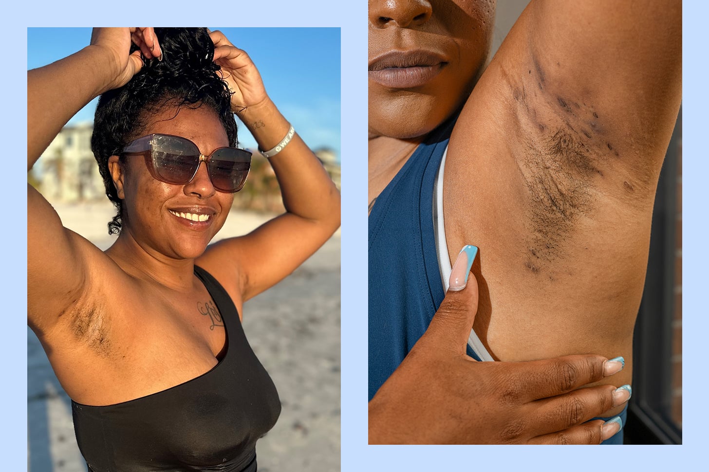 How I Learned to Love My Bumps and Scars From Hidradenitis Suppurativa