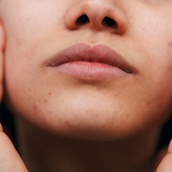 How to Get Rid of Acne Scars, According to Dermatologists