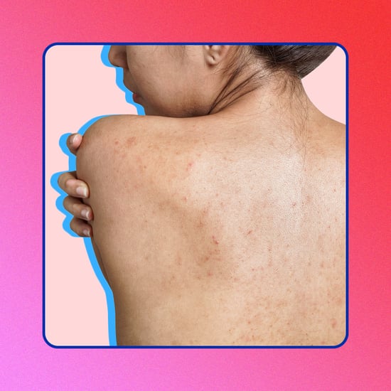 How to Get Rid of Acne Scars, According to Dermatologists