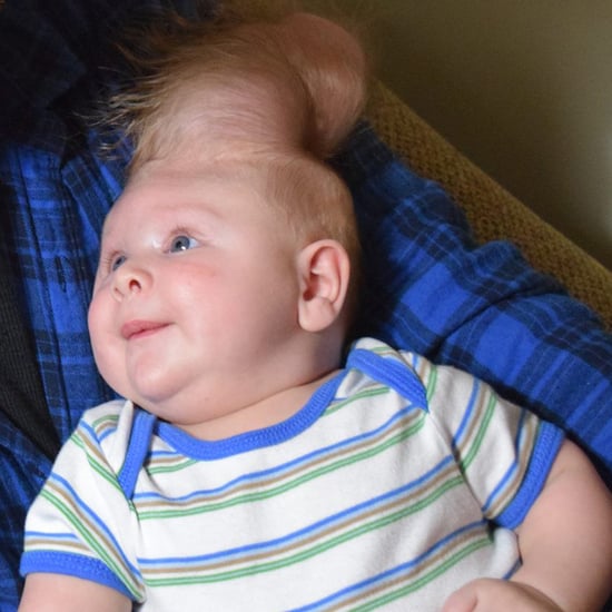 Boy Born With Brain Growing Outside of His Skull