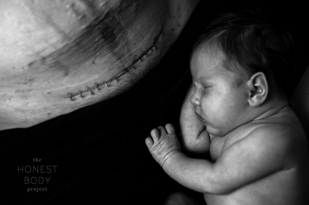 Honest Body Project Stapled C-Section Scar Photo Shoot
