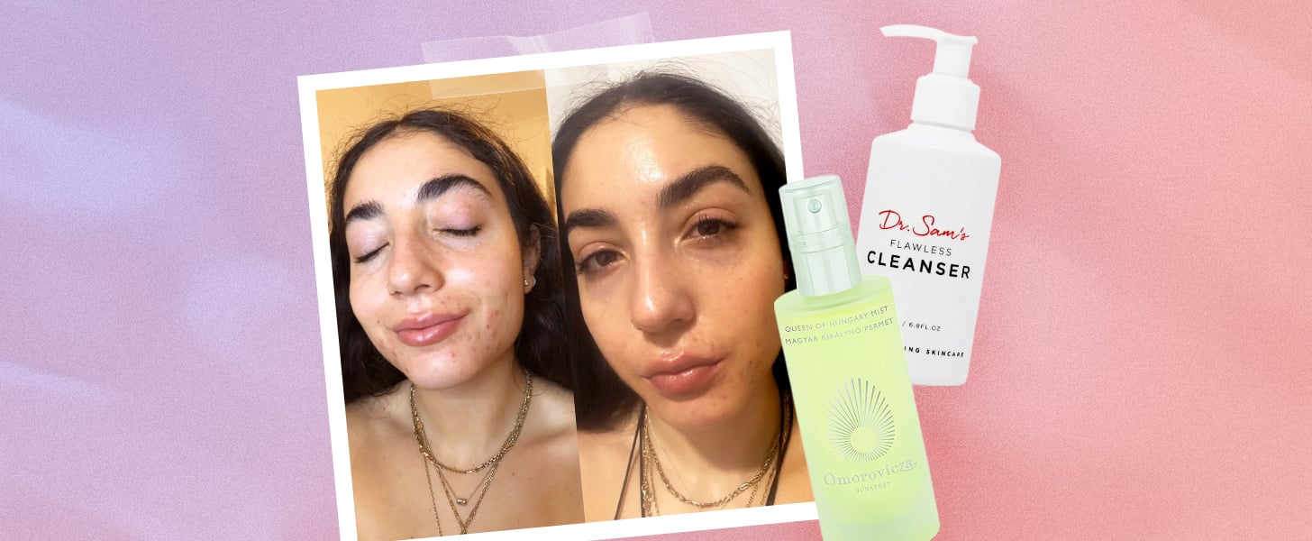 Keeping Acne Skin Hydrated on Accutane: An Expert Weighs In