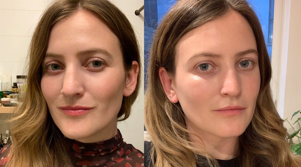 Before and After Undereye Fillers