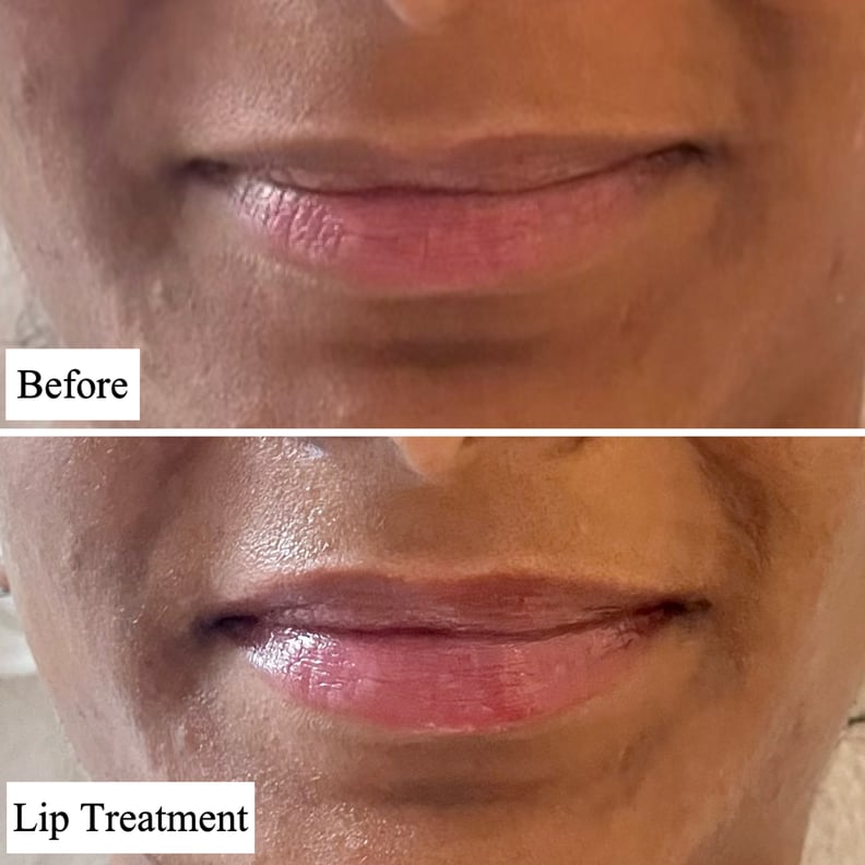 丹尼斯·格罗斯博士之前和之后使用护肤品DermInfusions丰满+修复唇治疗。