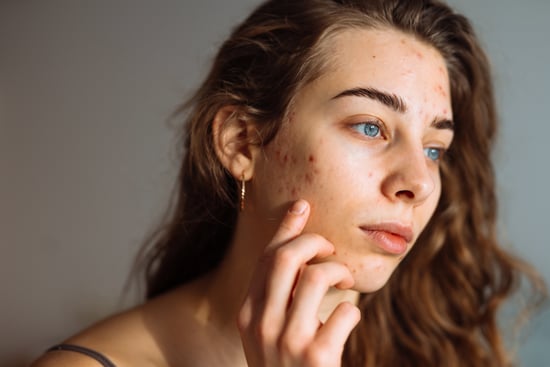 Can Your Mental Wellbeing Affect Your Skin? Experts Say Yes