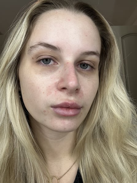 Taylor Wearing Differin Acne-Prone Skin Patches