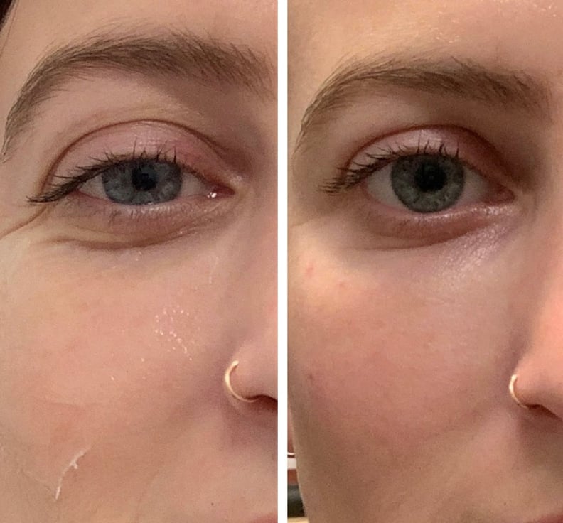Undereye Filler Before and After: Immediately After