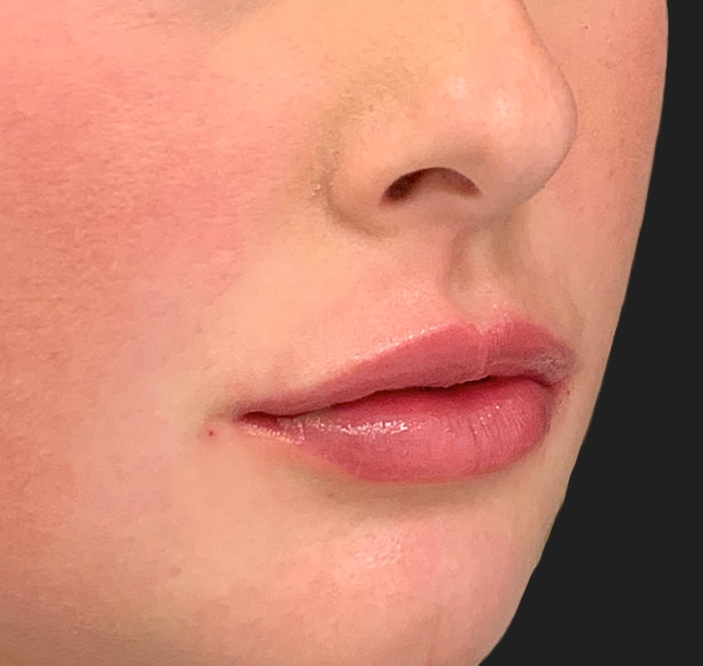 Correct Lip Filler Healing Process With Photos POPSUGAR Beauty UK