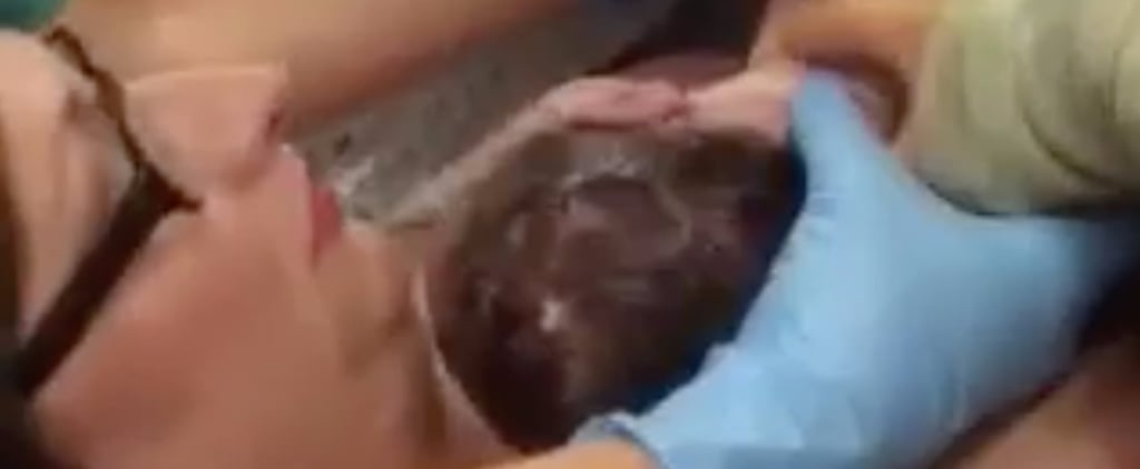 Baby Delivers Itself During C-Section Birth
