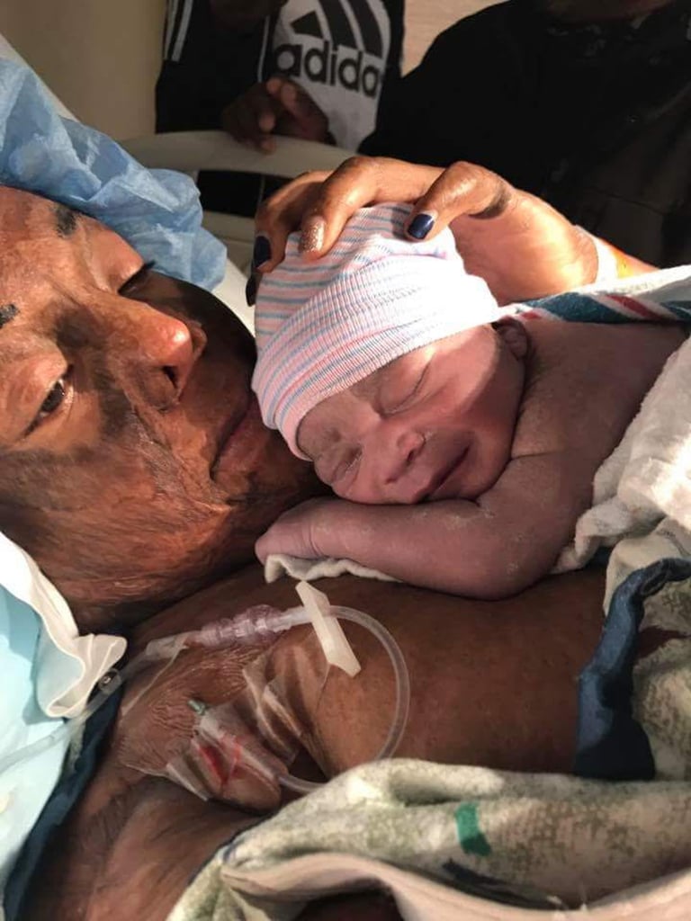 Burn Survivor Breastfeeding