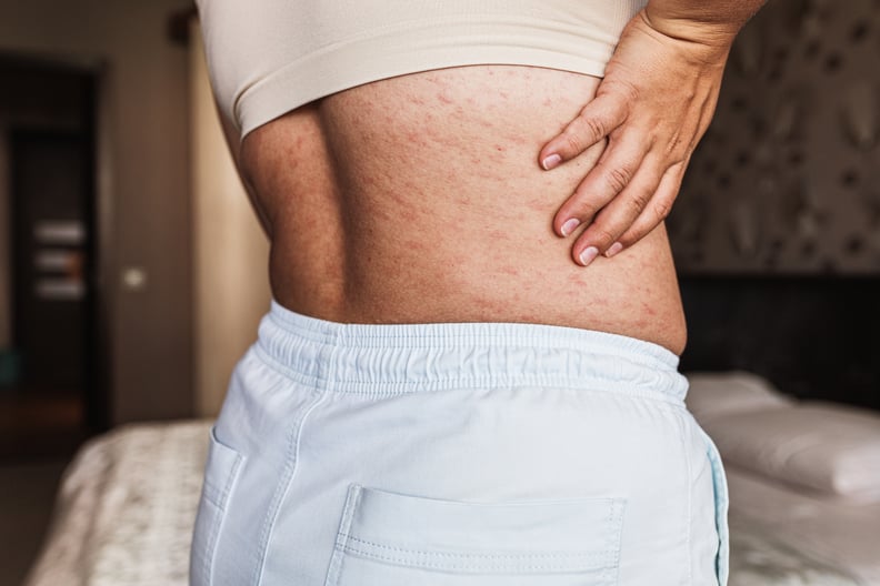 topical steroid cream withdrawal