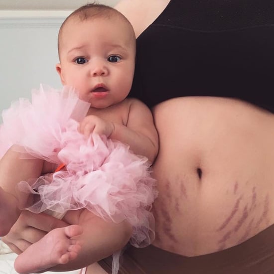 Mom's Powerful Message About Postpartum Stretch Marks
