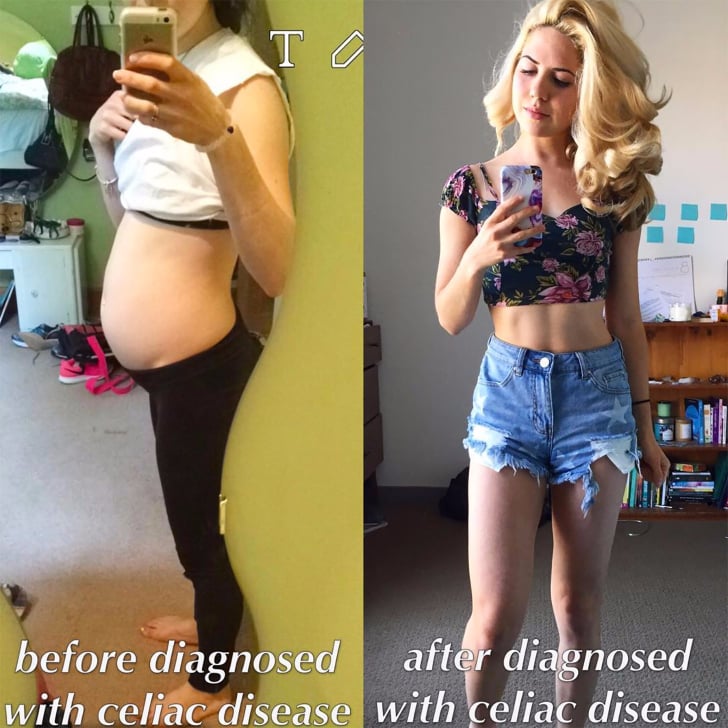 Celiac Disease Before and After Photos POPSUGAR Fitness celiac-disease-before-and-after-photos-popsugar-fitness