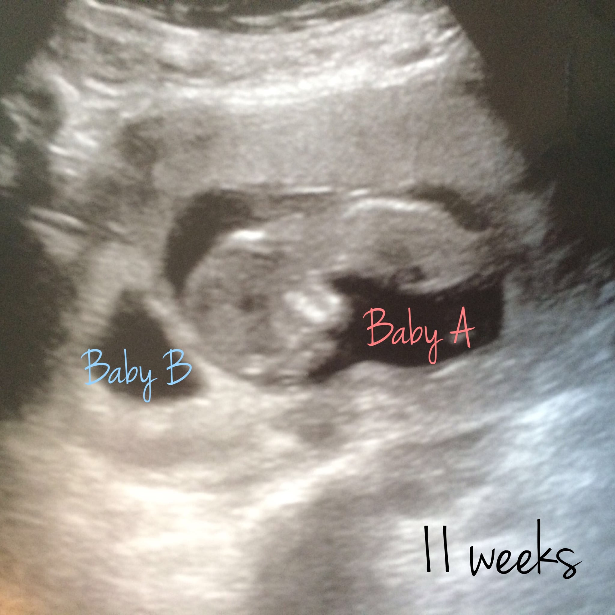 11-week ultrasound photo