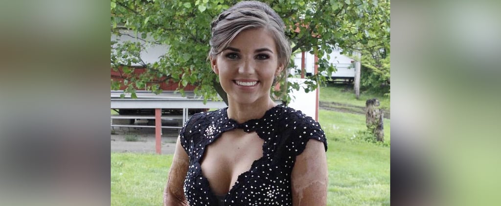 Burn Survivor Kilee Brookbank Named Prom Queen (Video)