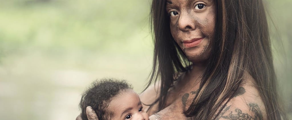 Burn Survivor Breastfeeding