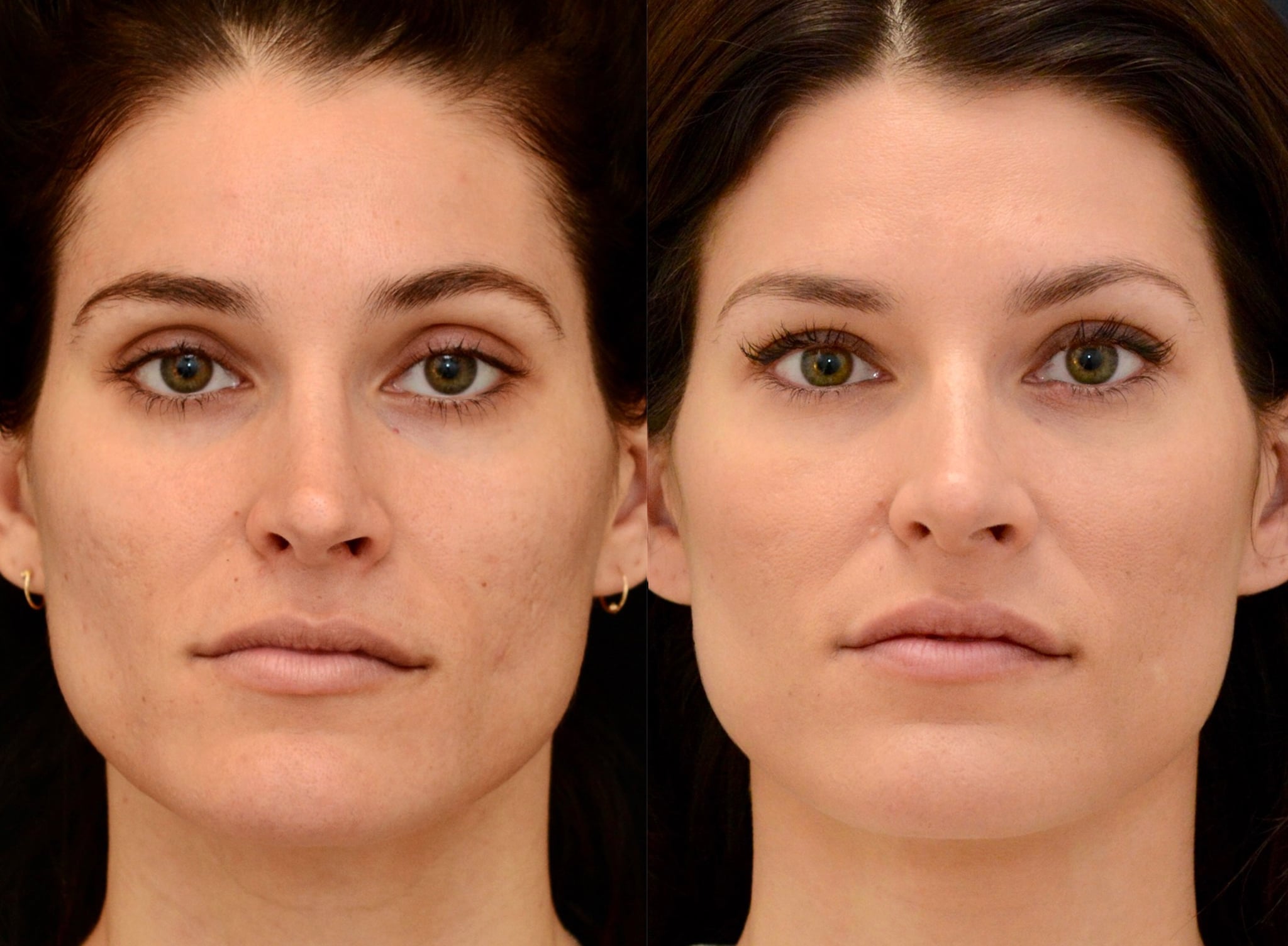 MIST™ Treatment for Acne Scars by Dr. Marc Mani