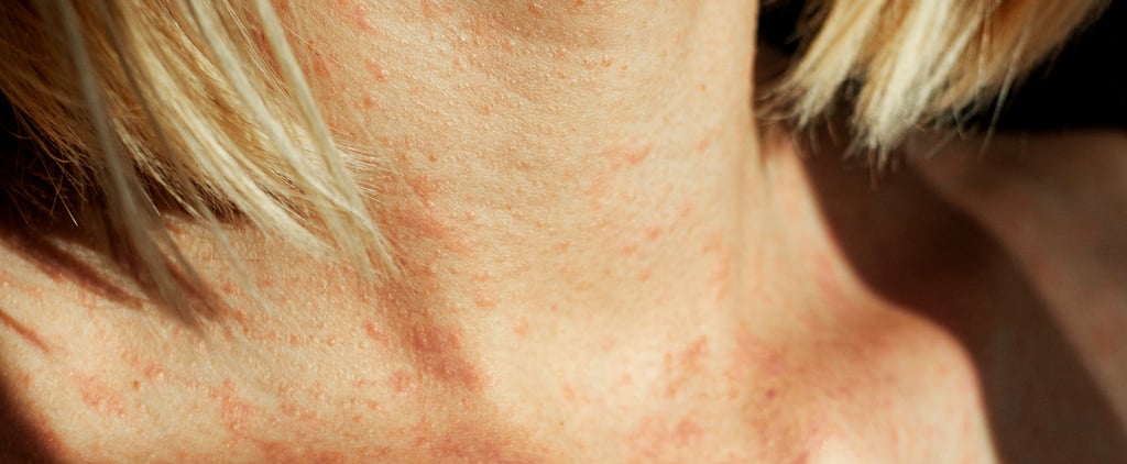 5 Eczema Hacks to Try, According to Doctors
