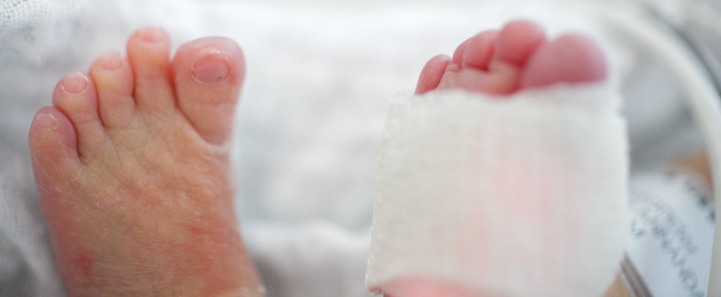 How to Get Rid of Hair Tourniquets From Baby Toes POPSUGAR Family