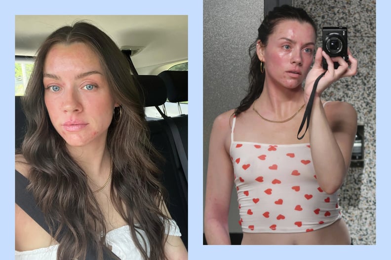influencer madeleine edwards is shown in side by side photos, both selfies showing her face and skin covered in eczema pathches.
