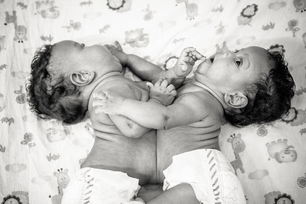Photographer Captures the Beauty of Conjoined Twins