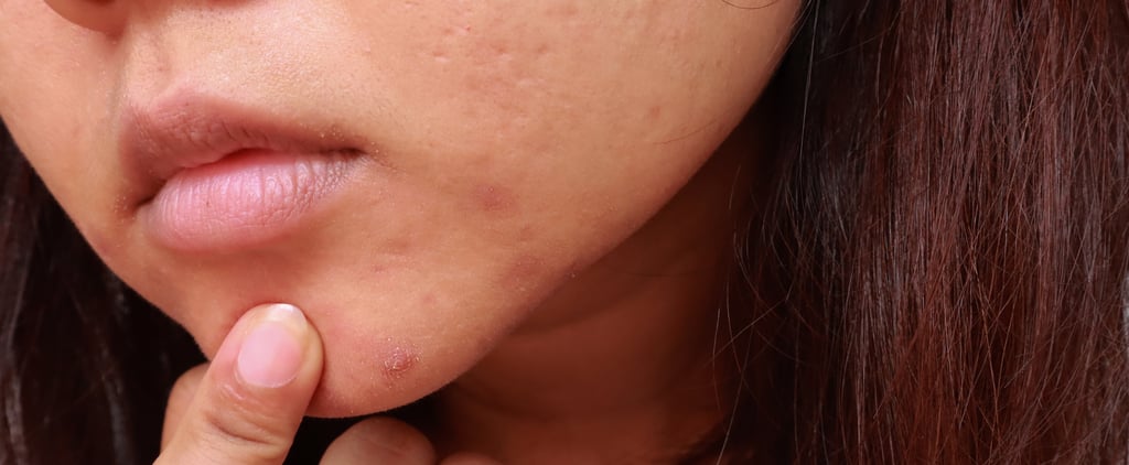 What to Know About Treating Cystic Acne, Per Dermatologists
