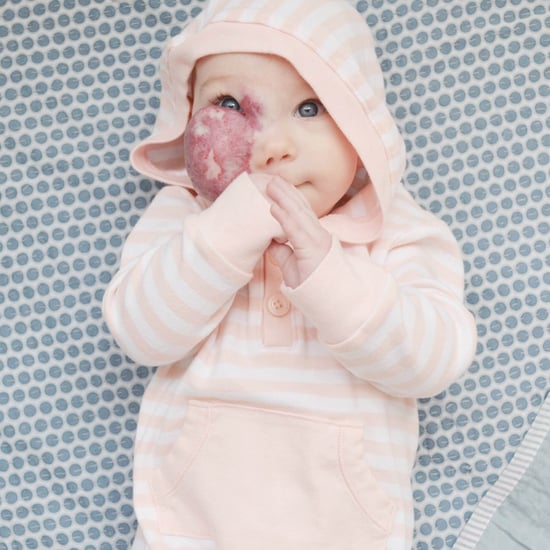 Baby With Capillary Hemangioma on Her Face