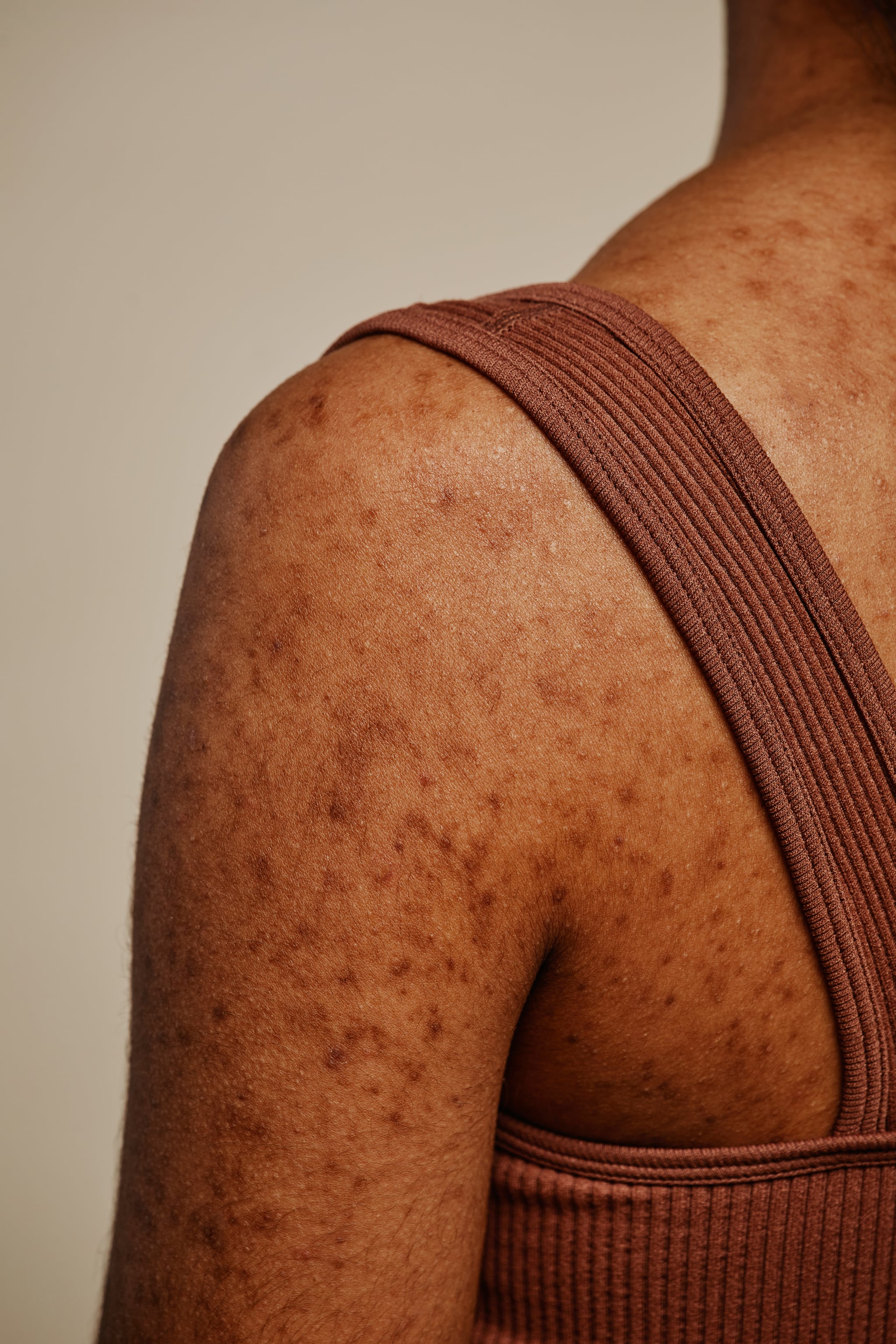 hidradenitis suppurativa on black skin