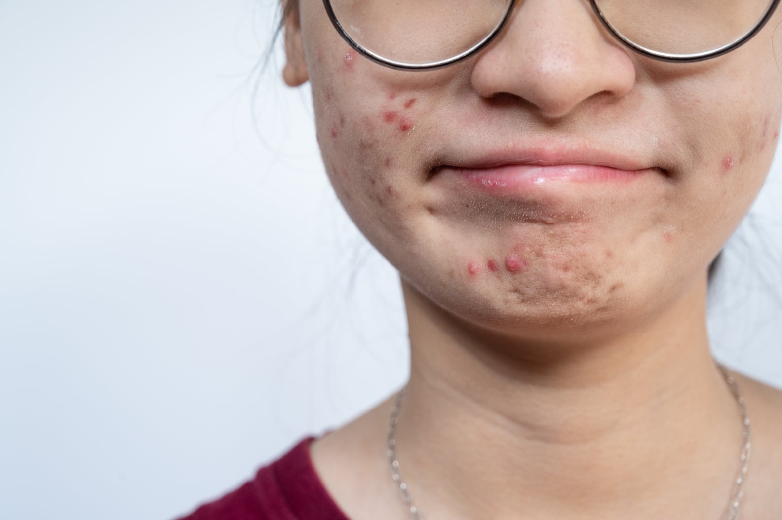 Prescription Products For Acne Popsugar Beauty