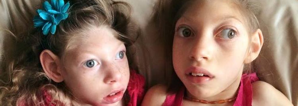 Baby Born With Zika-Linked Microcephaly