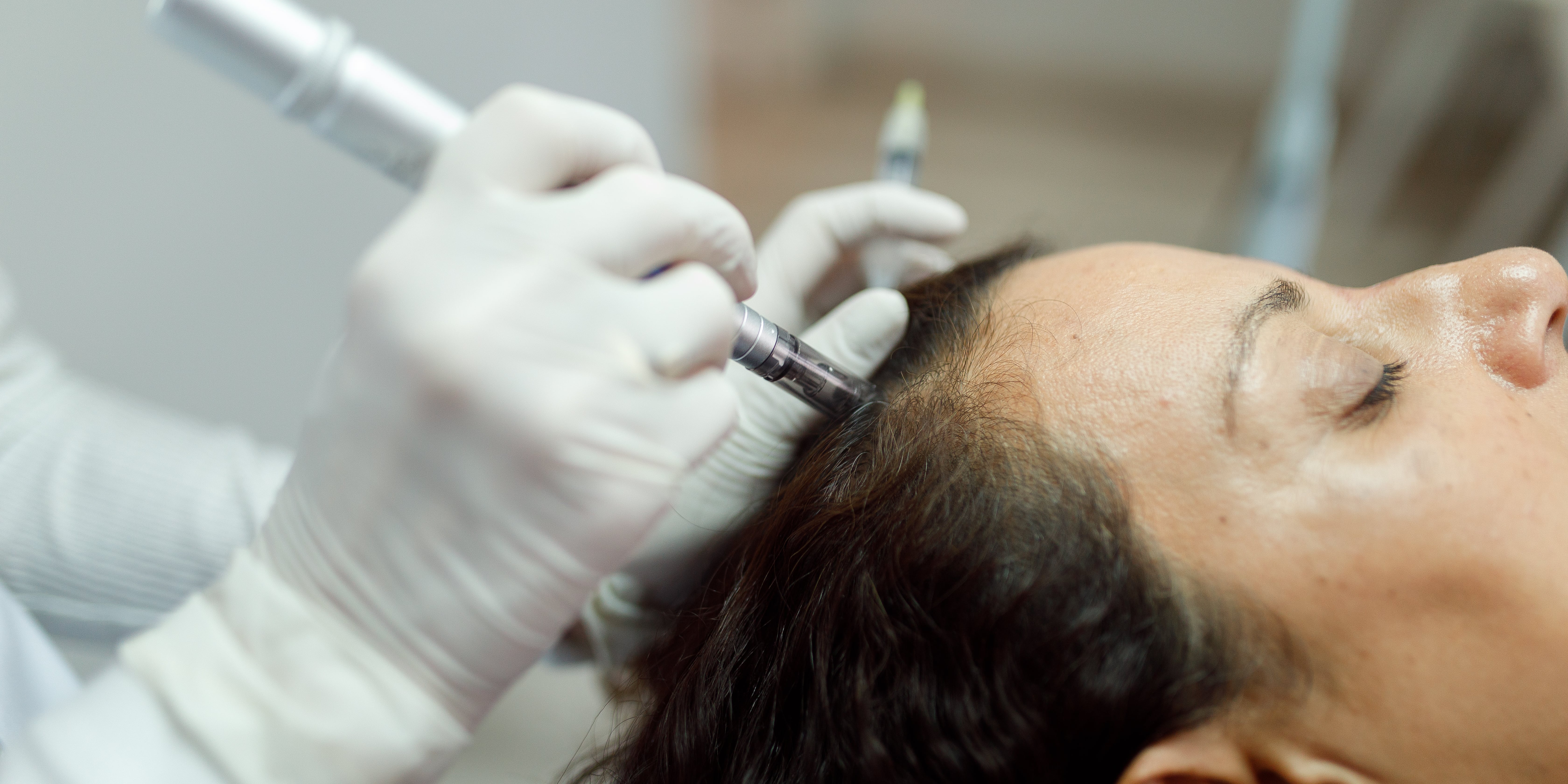 Scalp Microneedling: Cost, Benefits, and More - Vimarsana News