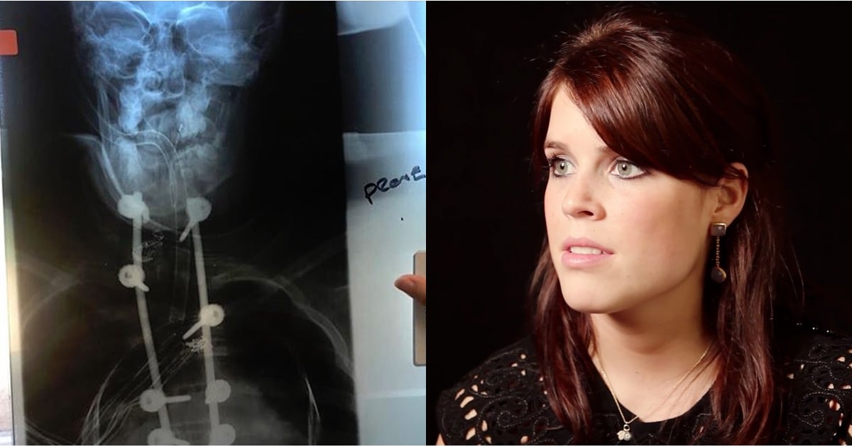 Princess Eugenie Scoliosis Surgery Photos July 2018 POPSUGAR Celebrity