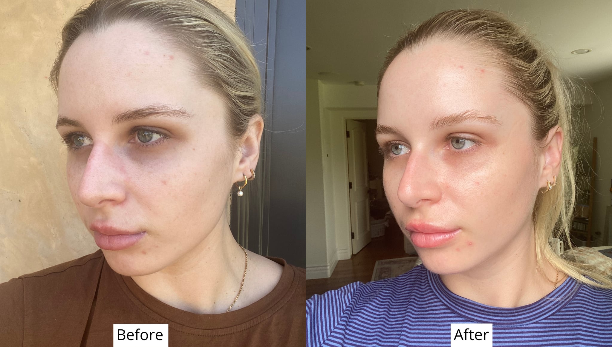 Before and after using CosRx blemish treatment serum