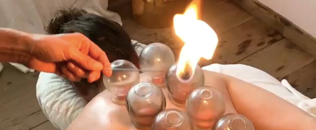 What Is Fire Cupping?