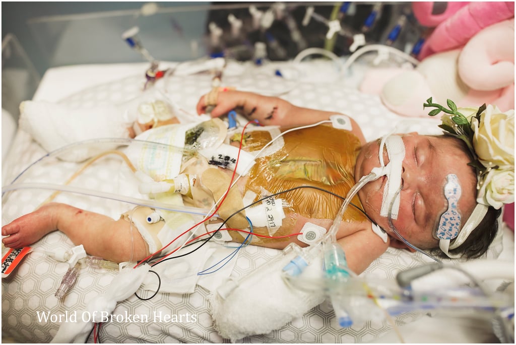 Twin With Heart Defect