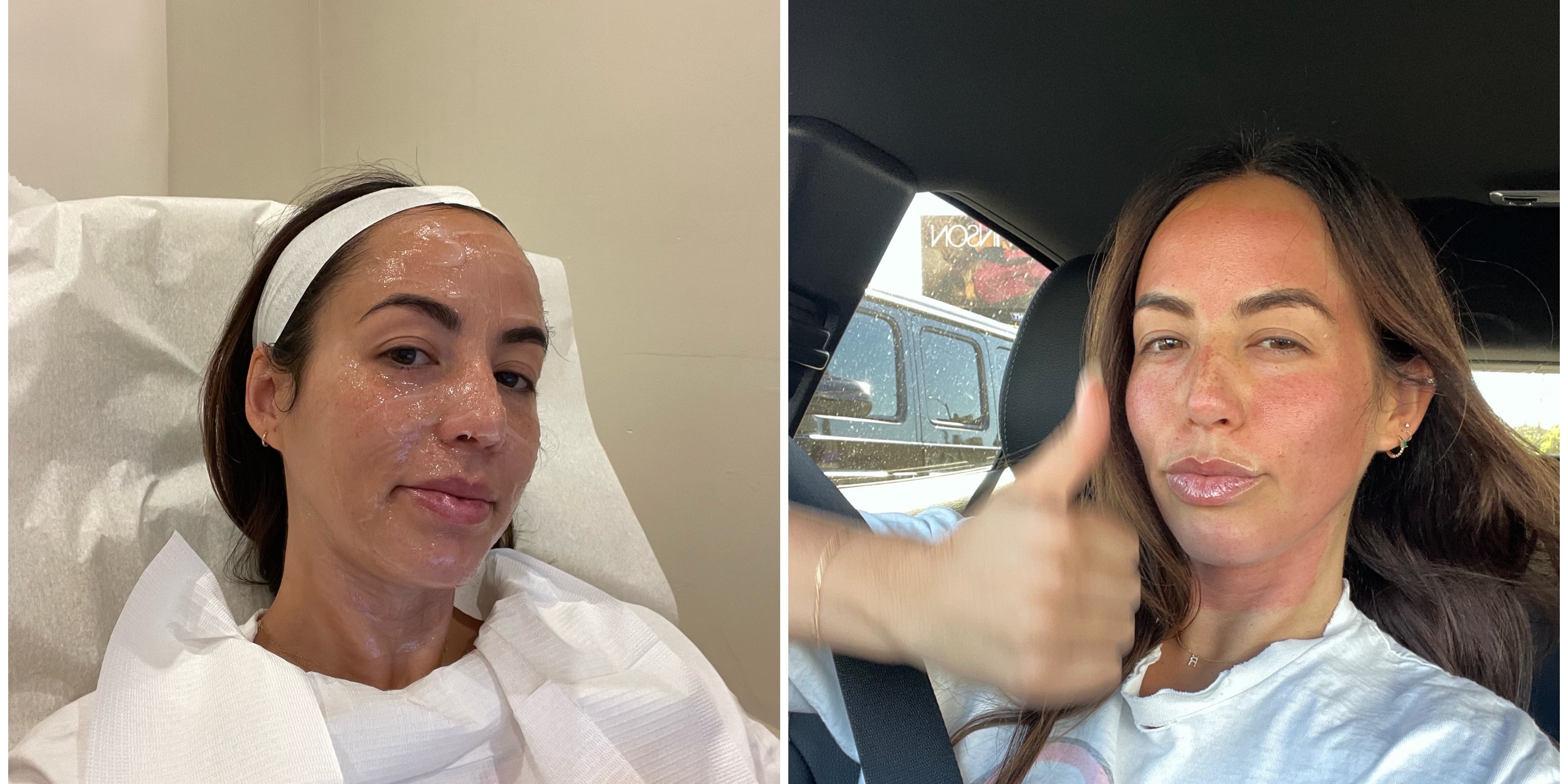 I Tried SkinPen, the Victoria Beckham-Approved Treatment - Vimarsana News