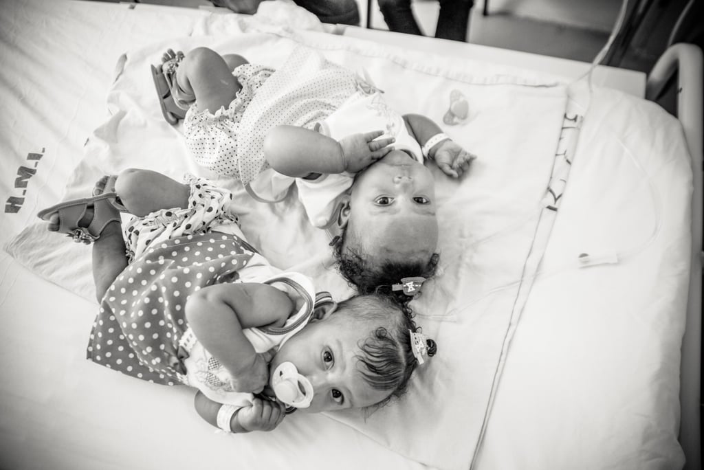 Conjoined Twins Are Separated and Photographed